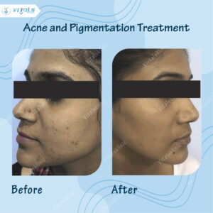  acne-pigmentation-treatment