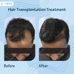 hair-translpant