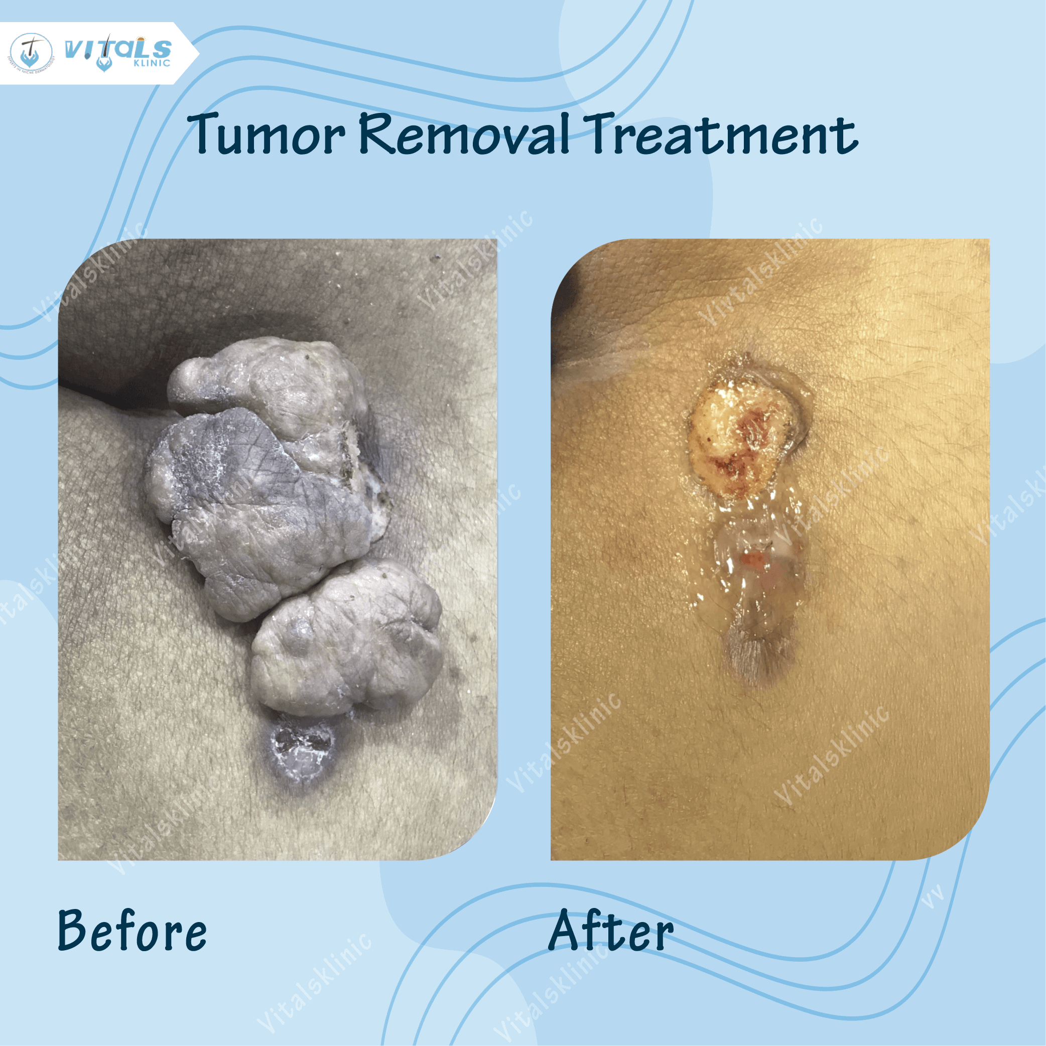 tumour-removal-treatment