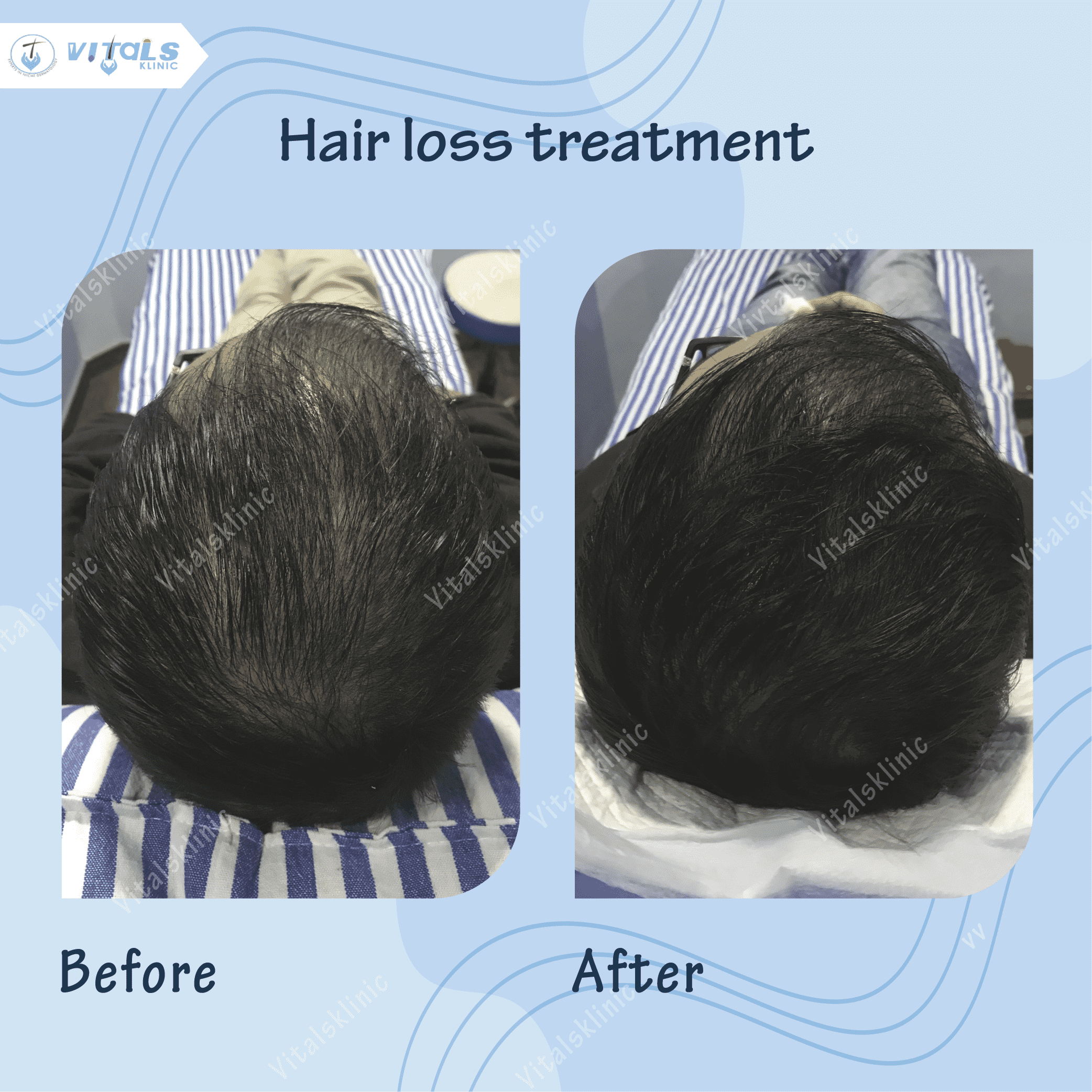 mole-removal-treatment-1