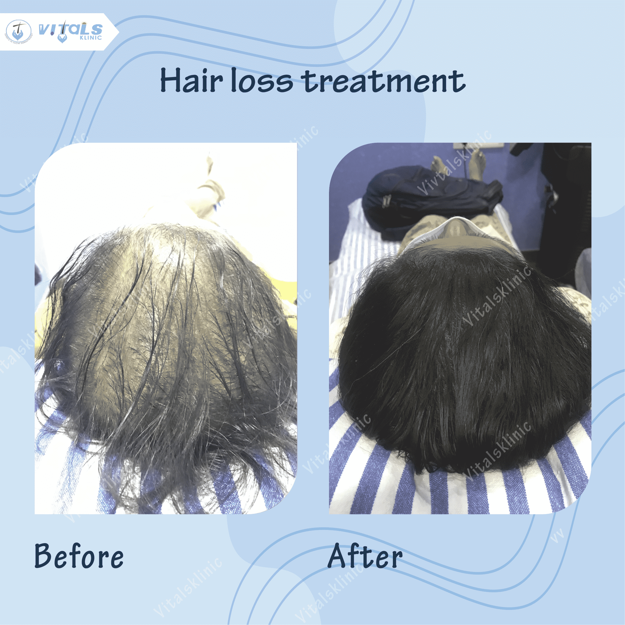 mole-removal-treatment-1