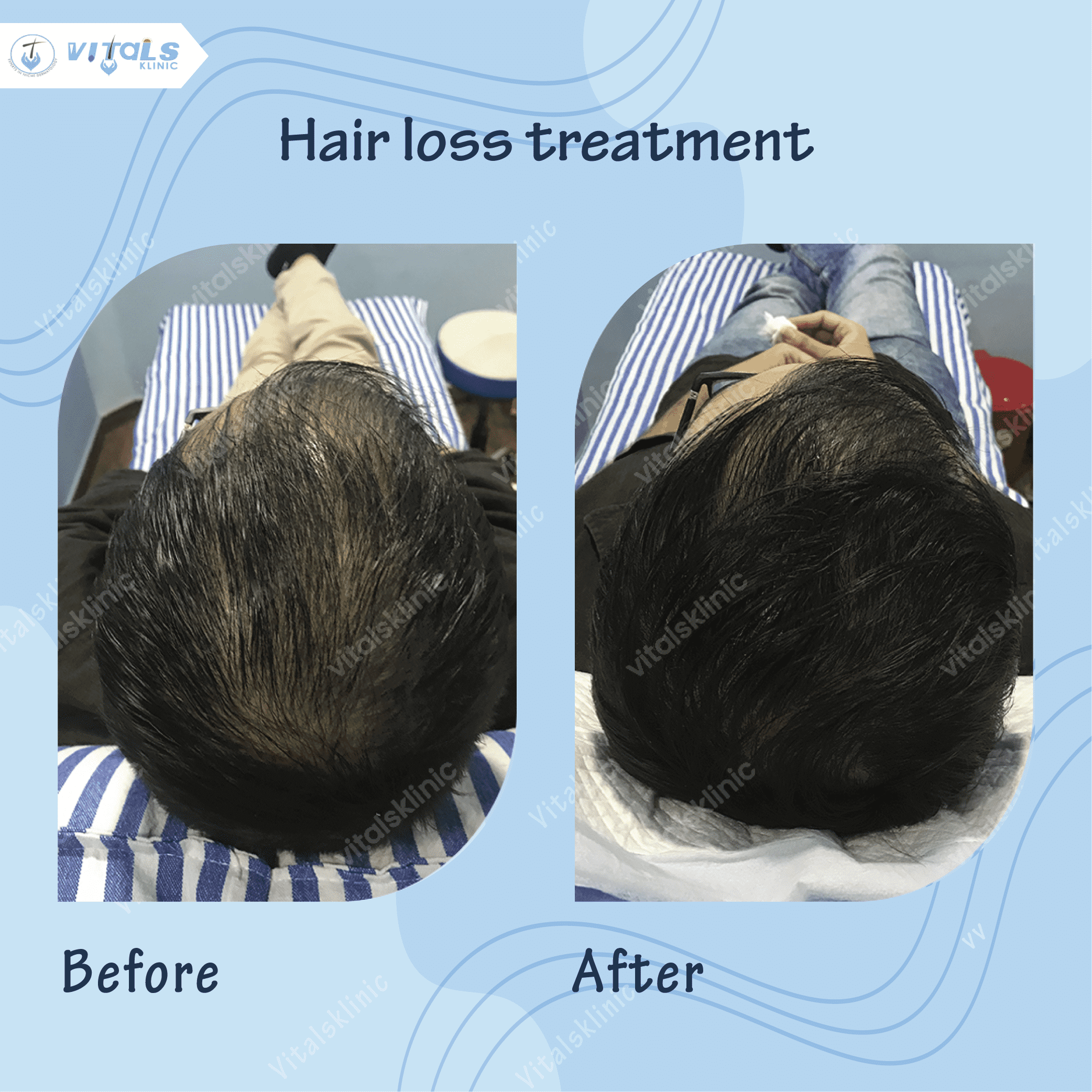 mole-removal-treatment-1