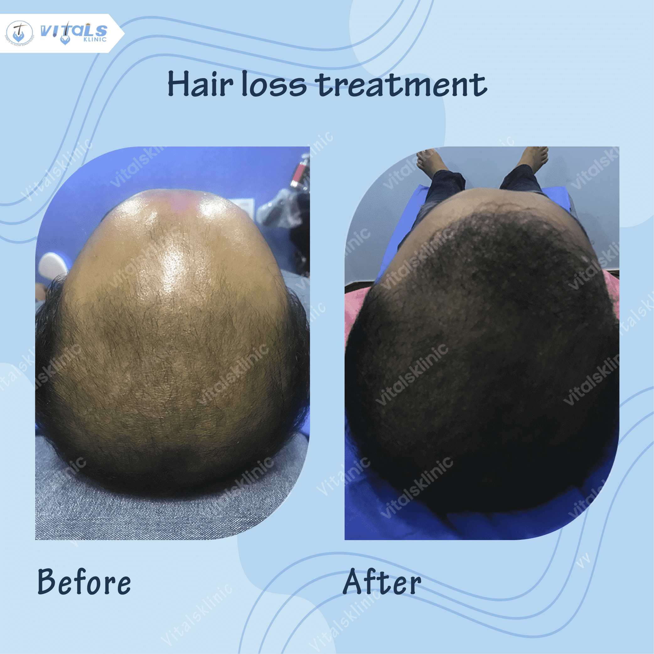 mole-removal-treatment-1