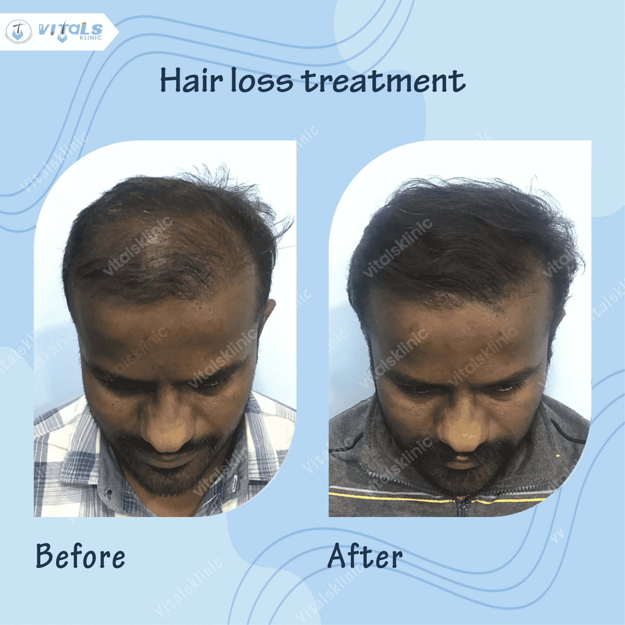 mole-removal-treatment-1