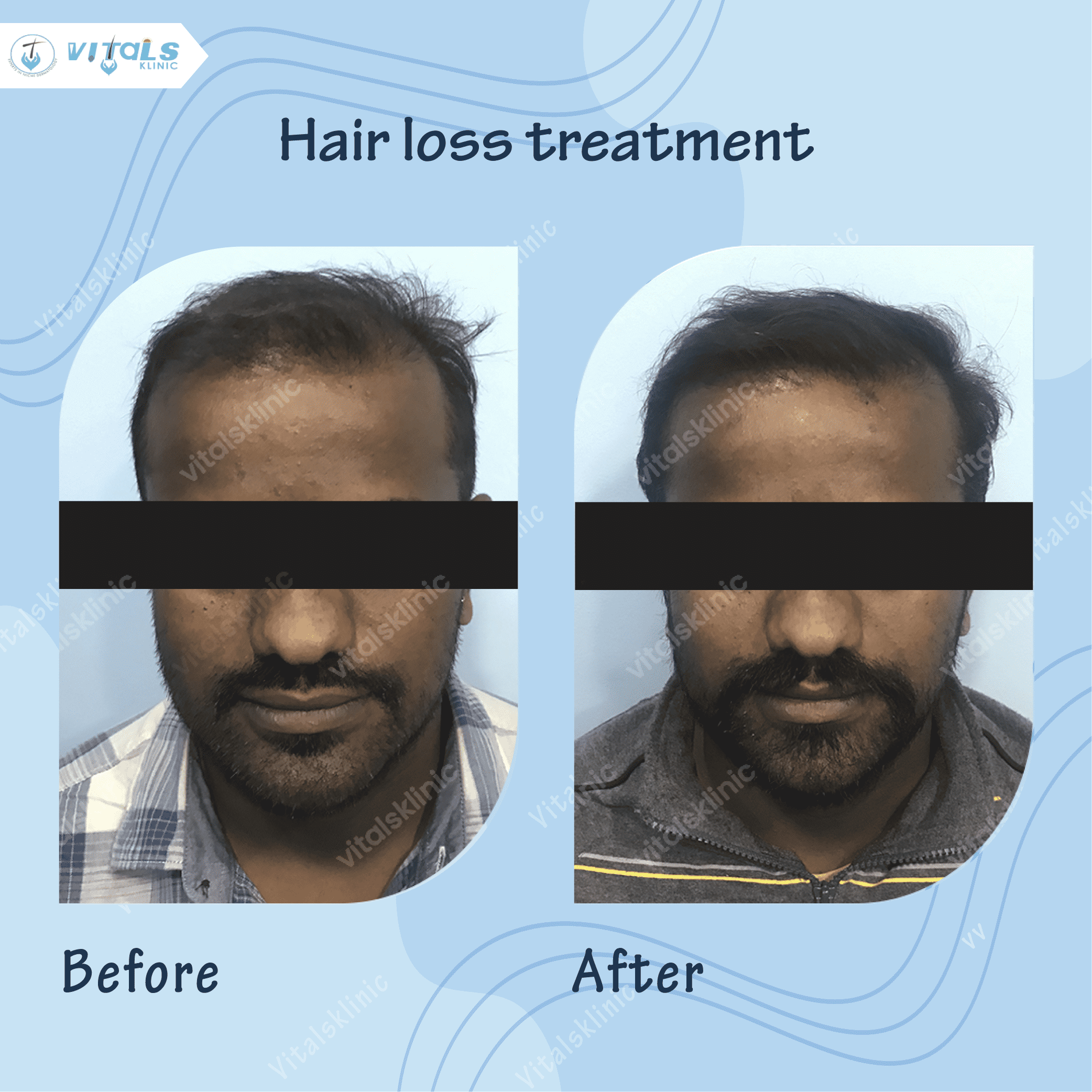 mole-removal-treatment-1