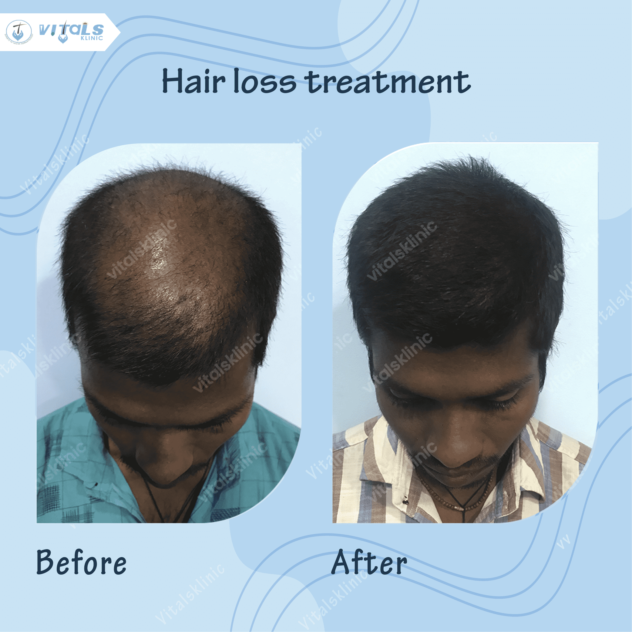 mole-removal-treatment-1