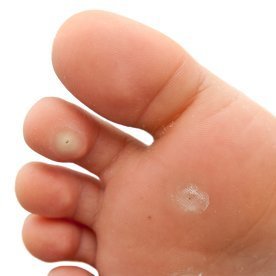 Wart Removal Treatment