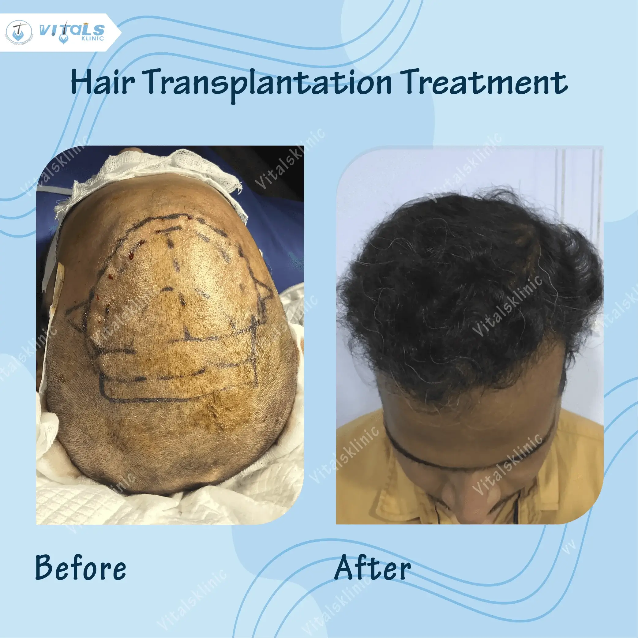 hair-translapate-treatment