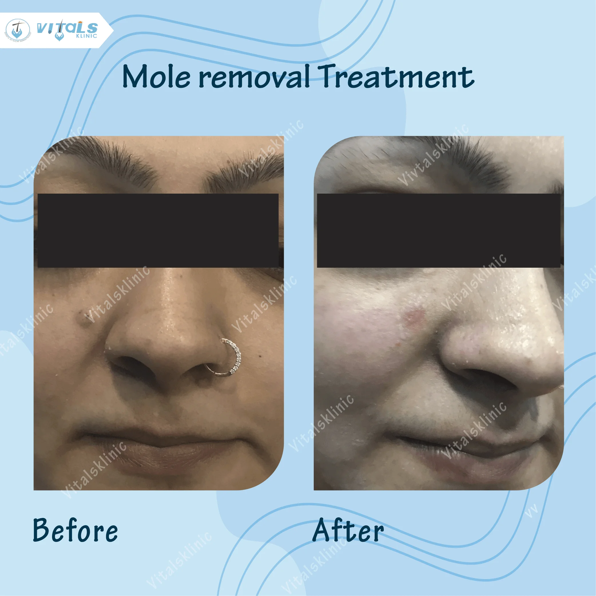 mole-removal-treatment