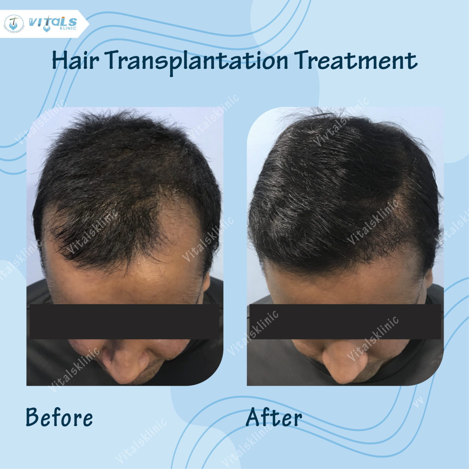 Hair Transplant in Bangalore - vitals