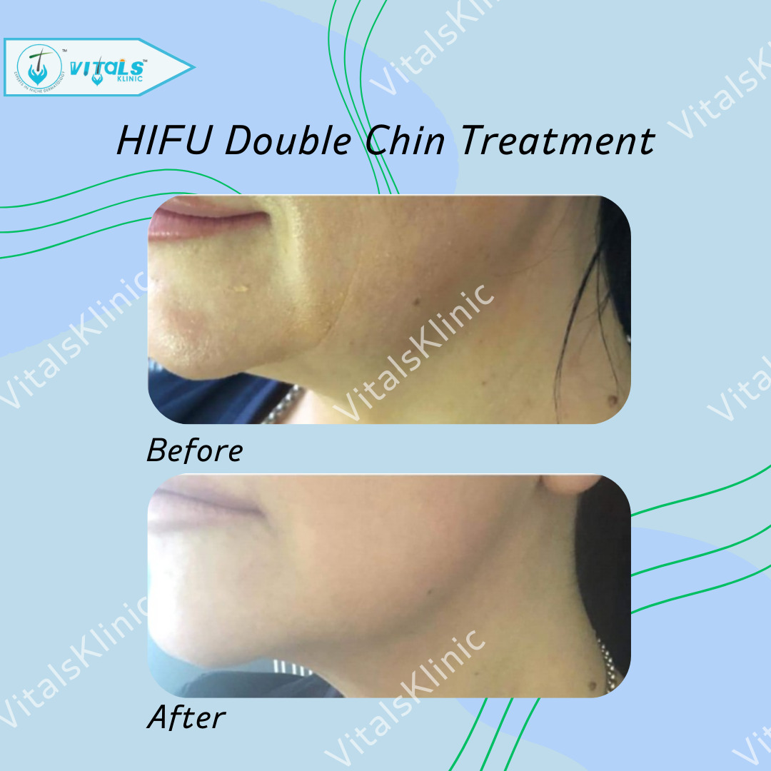HIFU-Treatment