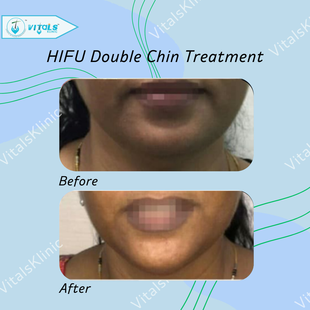 HIFU-Treatment