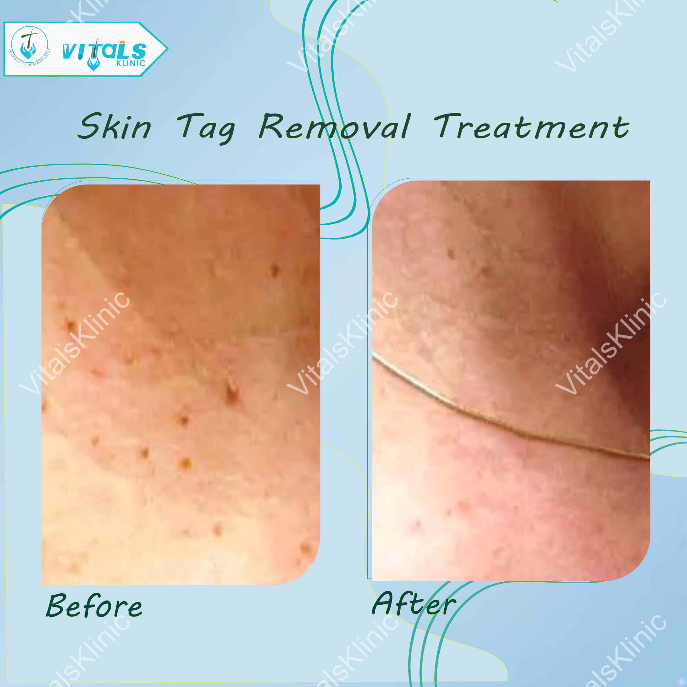 Skin Tag
